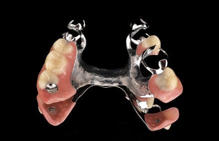 23. La prótesis esquelética terminada, con tope oclusal en el diente 17.