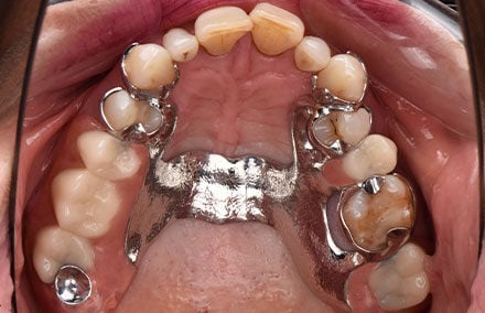 25. The finished model casting dentures with teeth from VITA VIONIC DENT DISC multiColor.