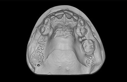 4. The master model and framework were  scanned for the digital workflow. 