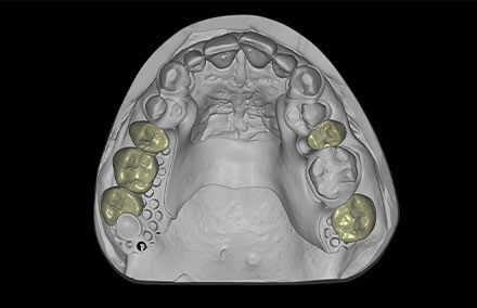 6. Die Konstruktion des Zahnmaterials in der exocad Software.