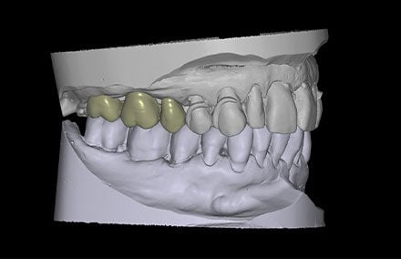 7. I denti 15, 16 e 17 sono stati progettati in blocco.