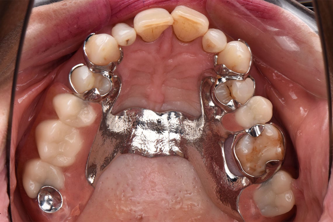 RESULT: The residual dentition in the maxilla after grinding clamps at 14, 24 and 26.