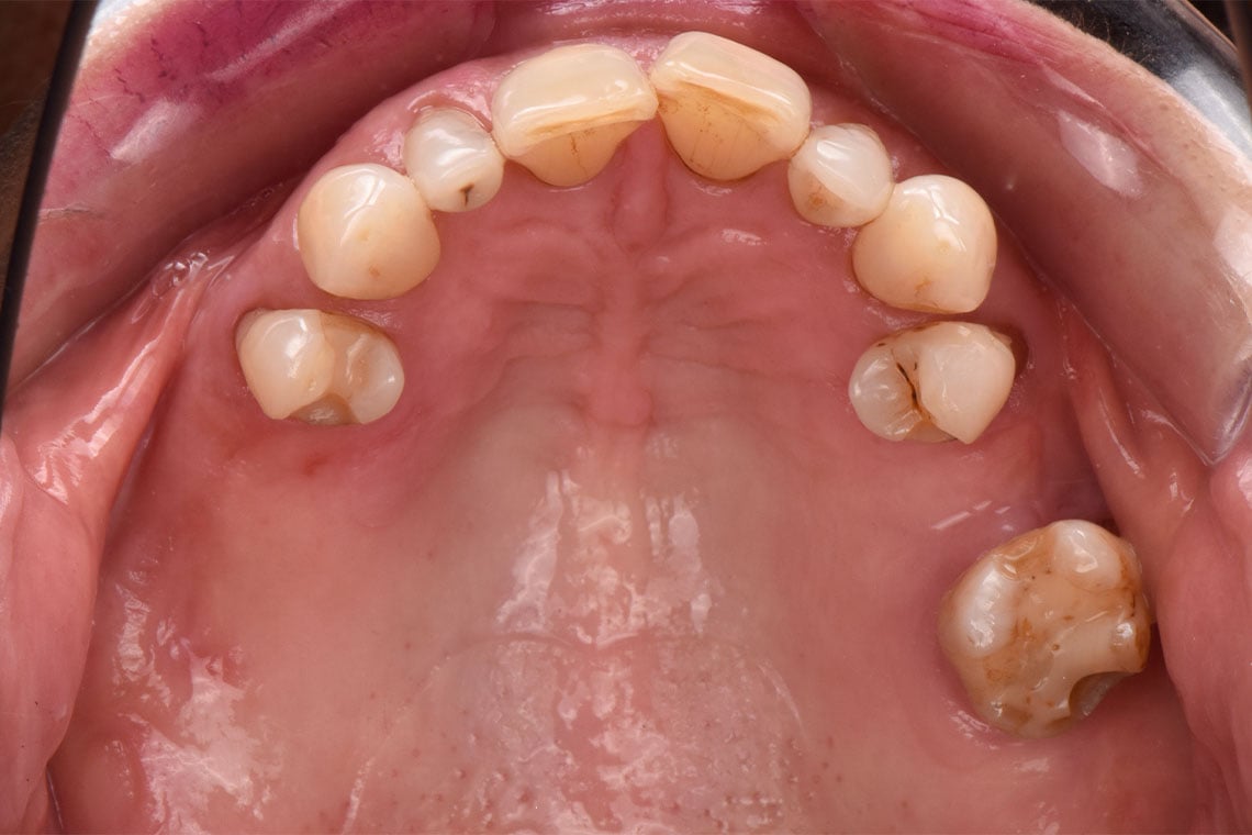 INITITAL SITUATIONS: The finished model casting dentures with teeth from VITA VIONIC DENT DISC multiColor.