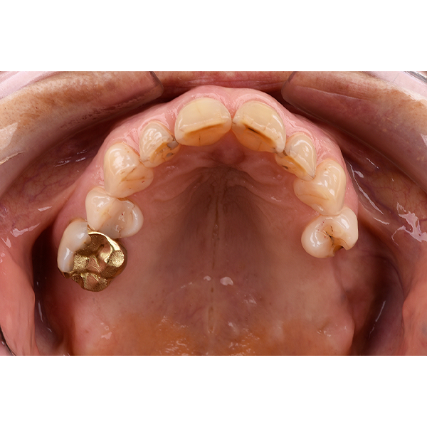 1. The initial situation with the missing teeth 17, 26 and 27.