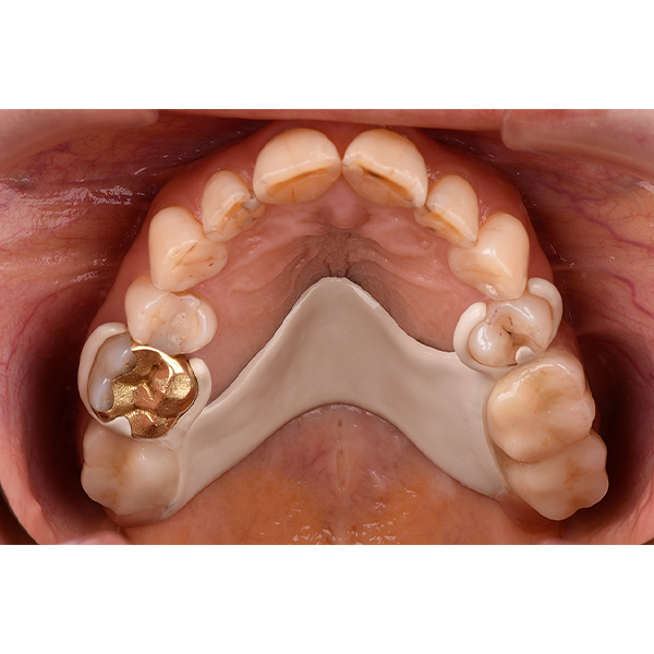 17. Vista oclusal de la prótesis parcial colocada.