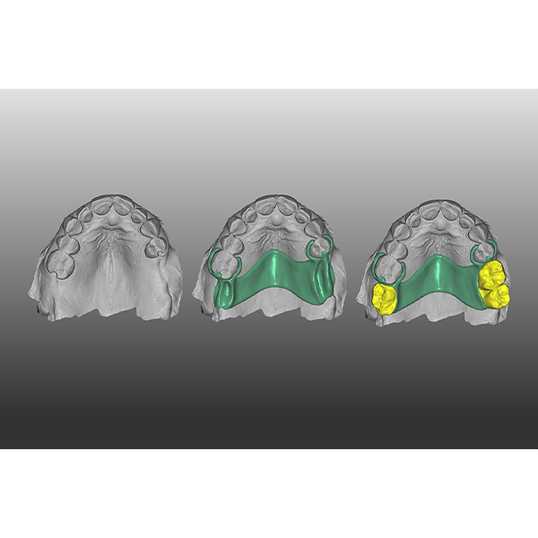 2. The design of the denture components in the exocad software.