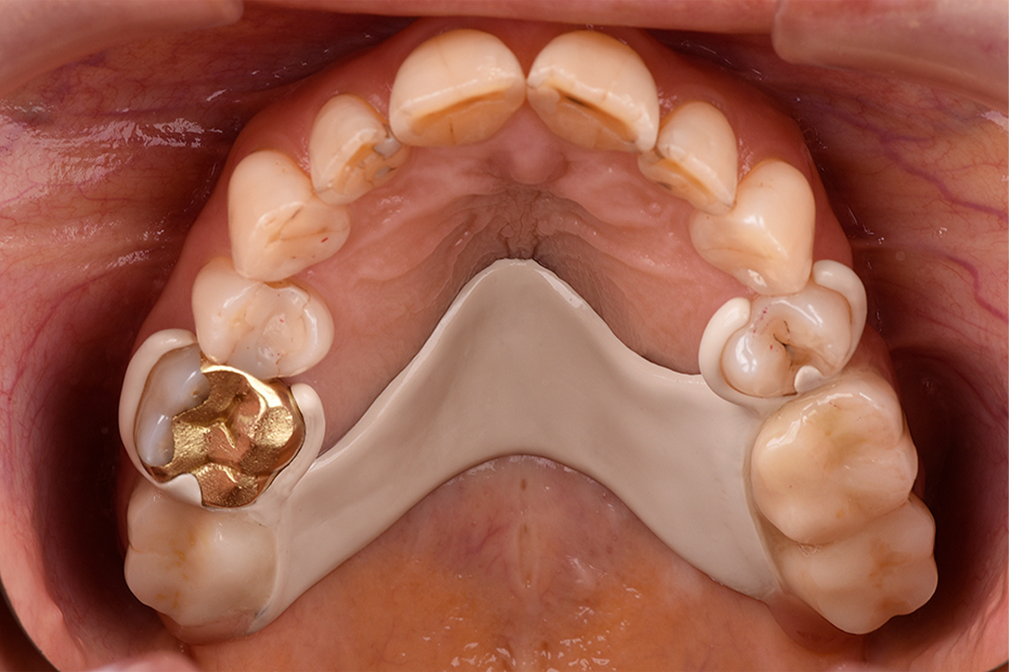 RESULT: Occlusal view of the integrated partial denture.