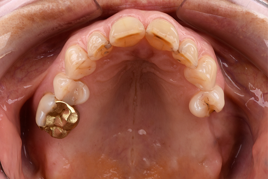 INITIAL SITUATION: The initial situation with the missing teeth 17, 26 and 27.
