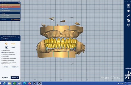 5.Urban Christen’s modelling of the denture base in the CAD software.