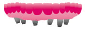 Implantatgetragene-14-gliedriege-Brücke_180x60