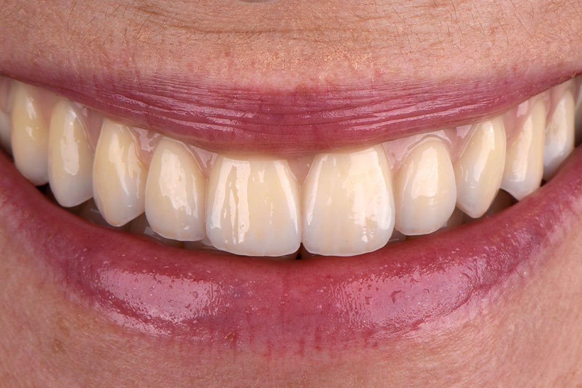 Dióxido de circonio para todos los casos: ¡capacidad de carga y estética allí donde se necesitan!