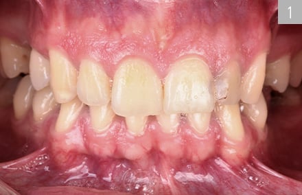Ausgangssituation mit dunkler Zahnfarbe und irregulären Zahnachsen.