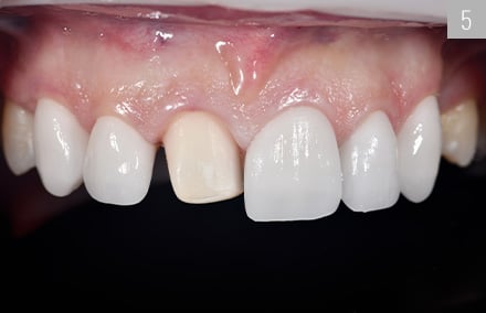 Gerade beim volladhäsiven Einsetzen wurden die irregulären Zahnachsen noch einmal deutlich.