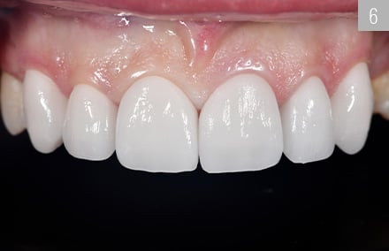 The bright restorative reconstruction result with bleach-colored VITABLOCS TriLuxe forte 0M1.