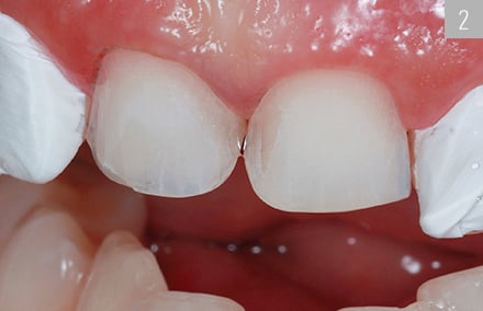 The minimally invasive preparation of 11 and 21 before the seating of the veneers.