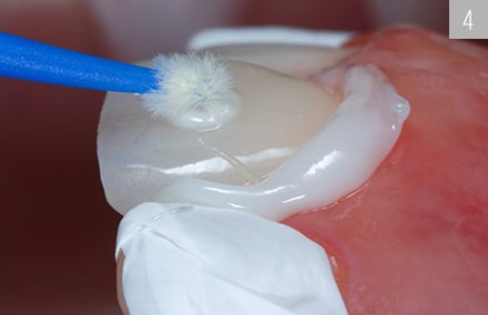 La colocación totalmente adhesiva de la carilla en el diente 21 con VITA ADIVA F-CEM.