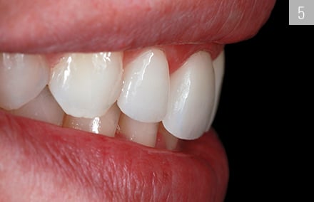 The harmonized dental arch in the lateral view.