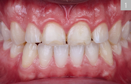 Initial situation with the severely abraded teeth 11 and 21.