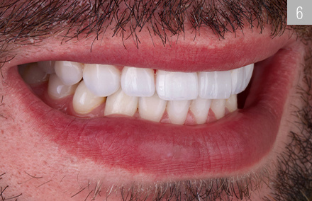 Lateral view of the bright, film-worthy smile.