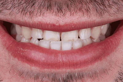 The perfect smile made of polychrome, bleach-colored VITABLOCS - Dr. Julian Conejo, Philadelphia, USA