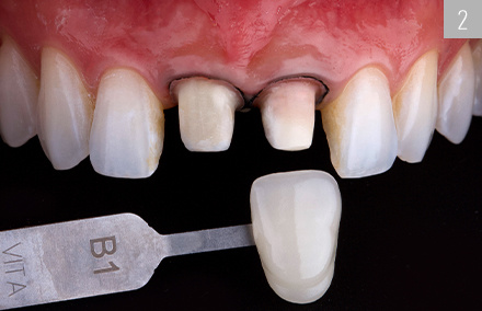 La détermination de la couleur de la dent a été réalisée avec le VITA classical A1-D4.