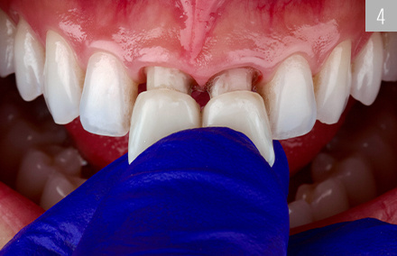 Tras el acabado, se procedió a la prueba clínica en boca de ambas coronas.