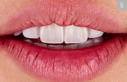 L'effet de couleur, la morphologie et la texture étaient en harmonie avec les dents naturelles et le tracé des lèvres.