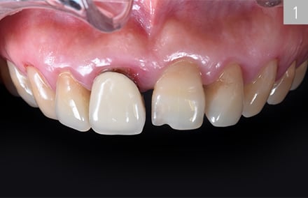 Situazione di partenza con la corona in metallo-ceramica sul dente 11, dall'aspetto insoddisfacente.