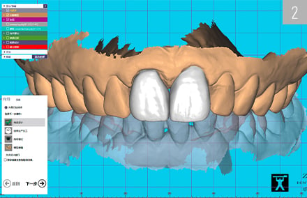 El diseño de las coronas de VITABLOCS TriLuxe forte en los dientes 11 y 21 en el software CAD.