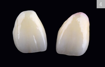 The two feldspar ceramic crowns before conditioning and integration.