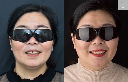 The patient in the before and after comparison was absolutely satisfied with the fast and highly esthetic restoration results.