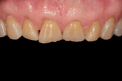 Restauración monolítica rápida de dientes anteriores con una dinámica lumínica óptima - Dr. Julio Gomez Paris, Rosario, Argentina
