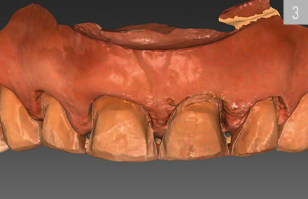 The scanned preparation of the upper jaw in the CAD software.