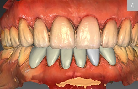 Les facettes maxillaires et mandibulaires construites dans le logiciel CAO.