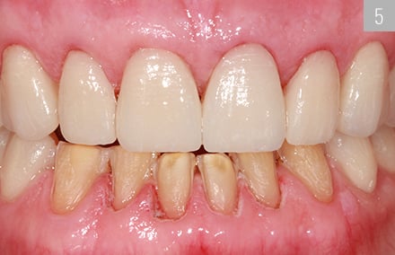 The veneers made from VITABLOCS TriLuxe forte following placement in the upper jaw.