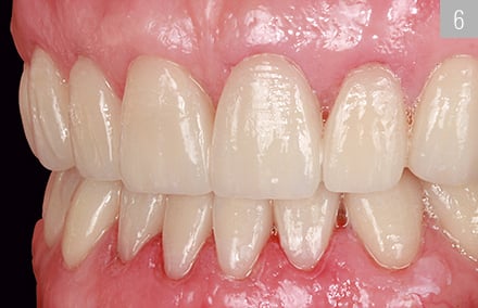 The highly esthetic rehabilitation following placement of the veneers in the lower jaw. 