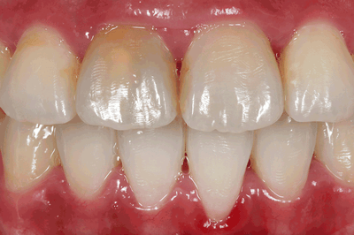 Lifelike front tooth reconstruction made of polychrome feldspar ceramics - Dr. Mon Li & ZT Sally Hsieh