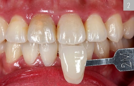 La couleur de dent 2M1 déterminée numériquement a été documentée à l’aide de la barrette de couleur échantillon correspondante.