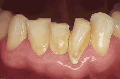 Veneers and crowns made from VITABLOCS TriLuxe forte - Dr. Andréas Powditch