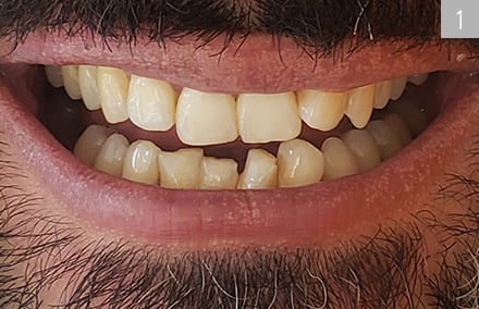 La ausencia del diente anterior 32 había causado inclinaciones en la arcada inferior.