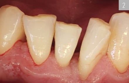 Because of a localized infection, the teeth were first cleaned professionally.