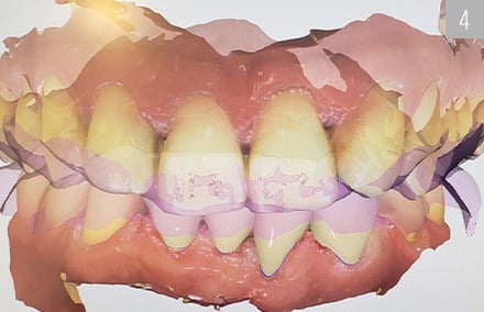 Los maxilares superior e inferior virtuales en articulación en el CEREC Smile Design.