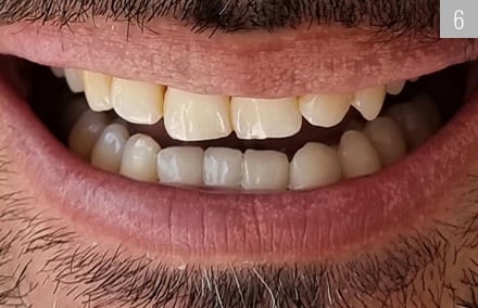 Las restauraciones de VITABLOCS TriLuxe forte colocadas en los dientes 33, 31, 41 y 42.