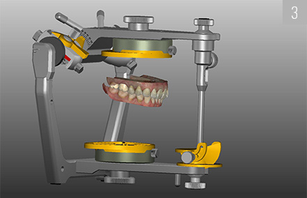 Function check of the exocad software's virtual articulator.