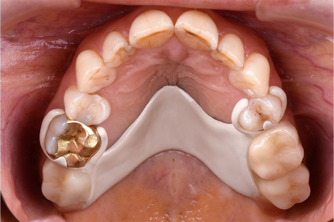 Precision-fit premium teeth from the polychromatic disc.